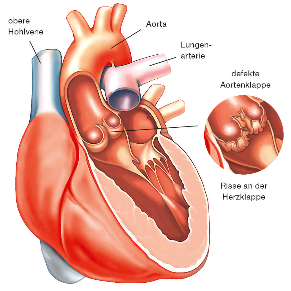 Querschnitt vom Herzen mit Lupe auf Aortenklappe